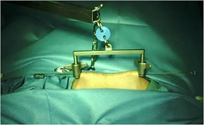 The comparison of gasless and traditional robot-assisted transvaginal natural orifice transluminal endoscopic surgery in hysterectomy